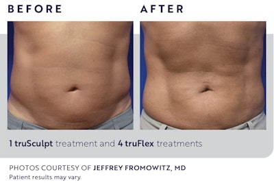 Cutera Before After2