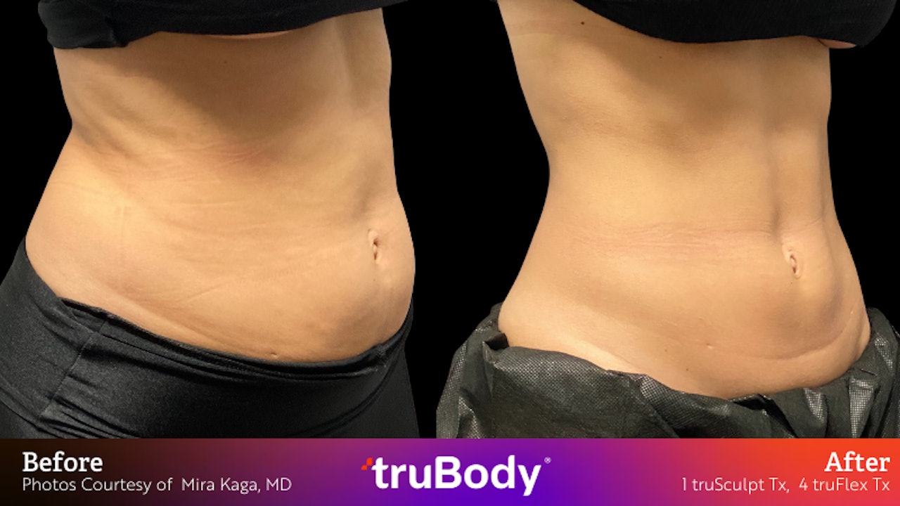 Say goodbye to stubborn fat and hello to a more toned and contoured body  with truBody. Our Body Contouring treatment is personalised to