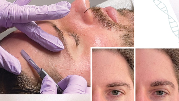 Go Beyond the Shave with Dermaplaning