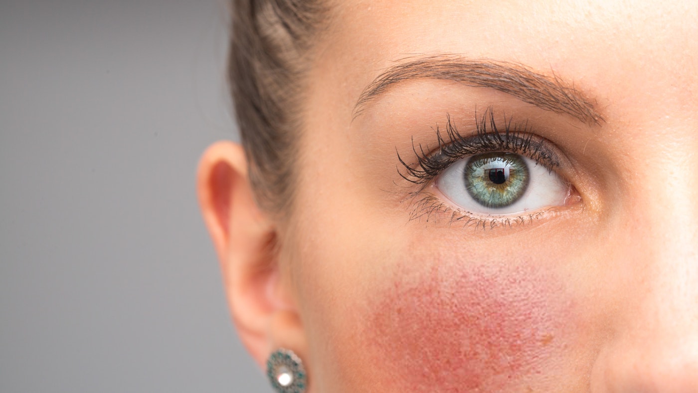 Rosacea Awareness Month: The Dangers of Antibiotic Resistance ...