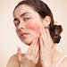 AARS Introduces #RosaceaRescues During Rosacea Awareness Month
