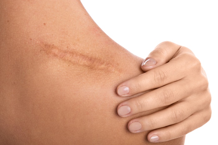 Hair transplants may facilitate architectural and genetic shifts in scars toward a profile of healthy, uninjured skin.