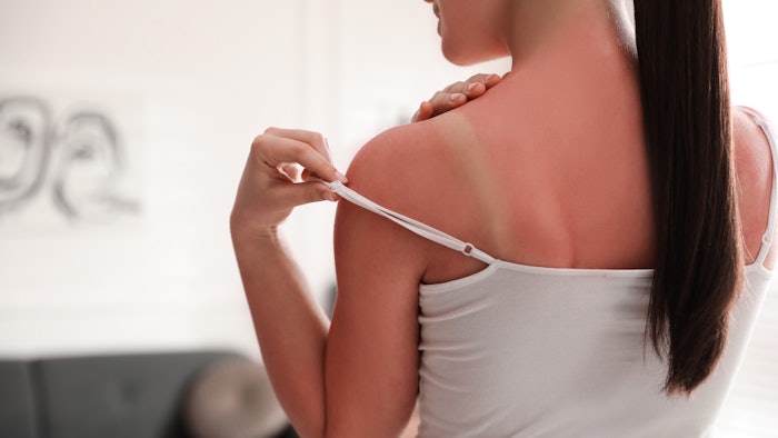 Survey Reveals Gen Z is Unfamiliar with Sunburn & Tanning Risks