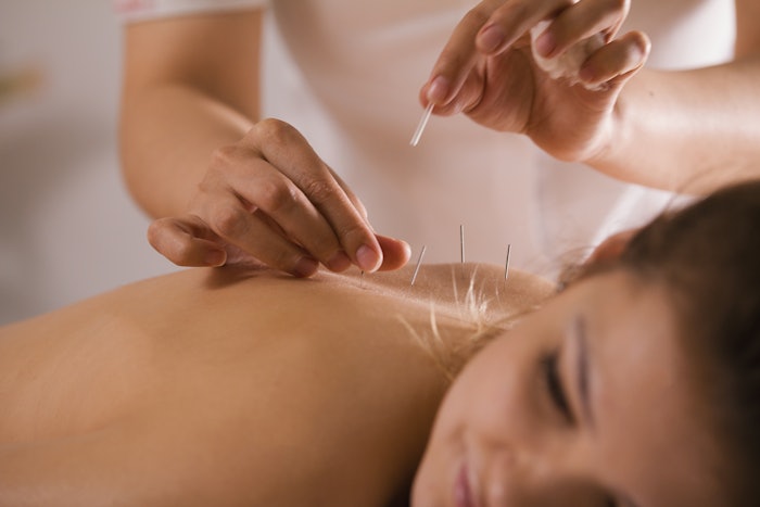 Alternative medicine doctor sticks needles into the girl's body on the acupuncture - close up
