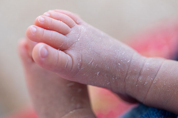 infant baby feet with dry skin Atopic Dermatitis