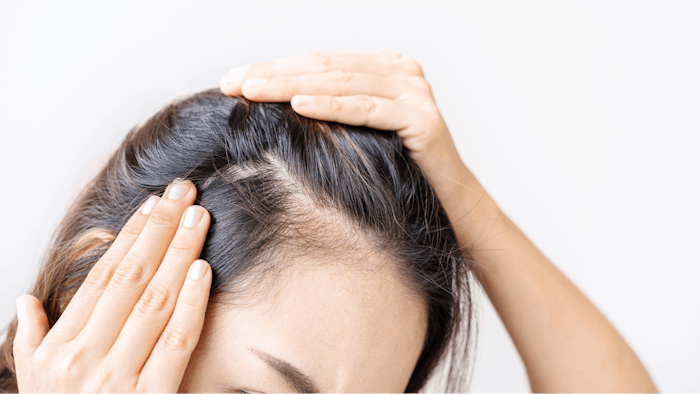 asian woman with hair loss
