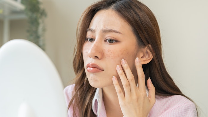 Woman with acne on her face