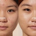 before and after pics of woman after acne treatment