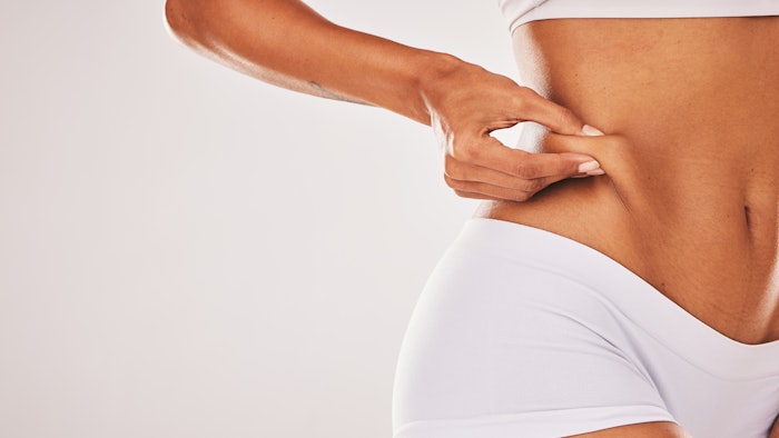 Sirnaomics recently announced positive interim results of an ongoing Phase I clinical trial of STP705, an siRNA (small interfering RNA) drug candidate, for fat reduction in adults undergoing abdominoplasty.
