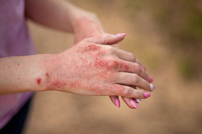 woman with atopic dermatitis