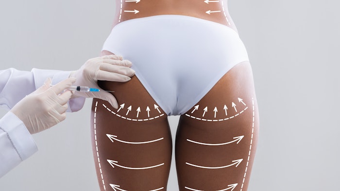 woman posing for BBL assessment