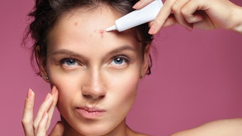 Scowling girl pointing at her acne and applying treatment cream. Photo of young girl with problem skin on pink background. Skin care concept