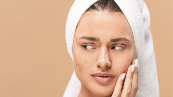 woman face with acne and looking away isolated on beige