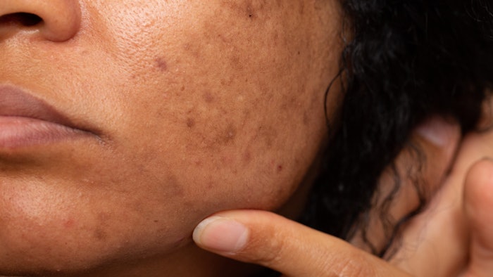 Closeup of Asian woman with melasma dark spots and freckles problems