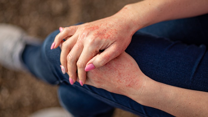 Close up dermatitis on skin