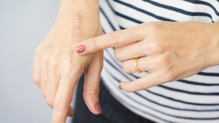 The skin damage in first-degree on outer layer skin