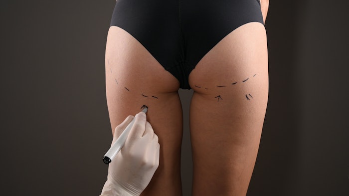 Closeup view of female buttocks marked for plastic operation, on gray background