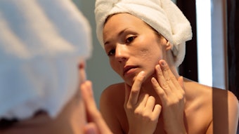 young woman looking her acne scars on the mirror