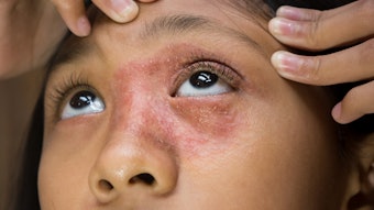 The research conducted at the center will focus on applicable scientific discoveries to advance allergy science and develop topical innovations to address skin conditions, per the organizations.