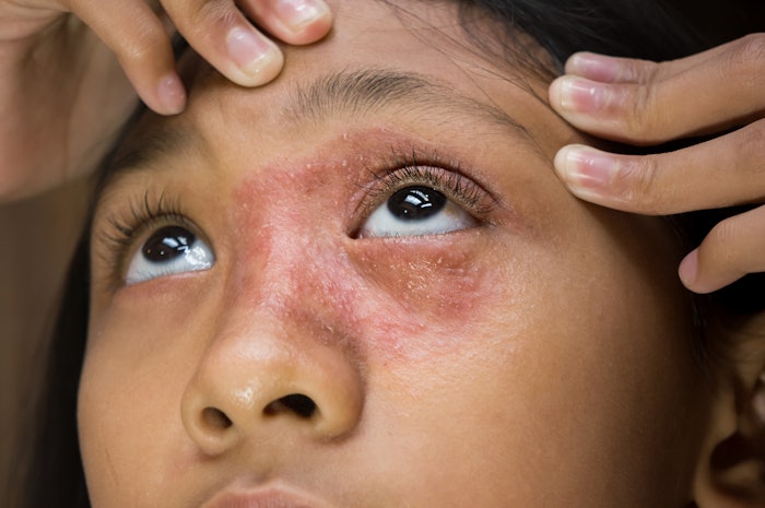 The research conducted at the center will focus on applicable scientific discoveries to advance allergy science and develop topical innovations to address skin conditions, per the organizations.
