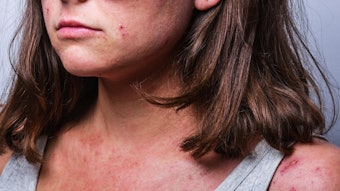 a young girl with atopic dermatitis in the acute stage. redness and scratching up to blood on the body close-up. dermatology