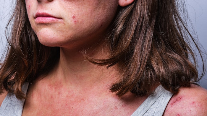 a young girl with atopic dermatitis in the acute stage. redness and scratching up to blood on the body close-up. dermatology