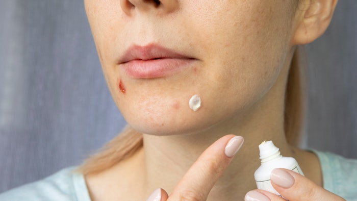 A girl applies a healing cream to acne on her face