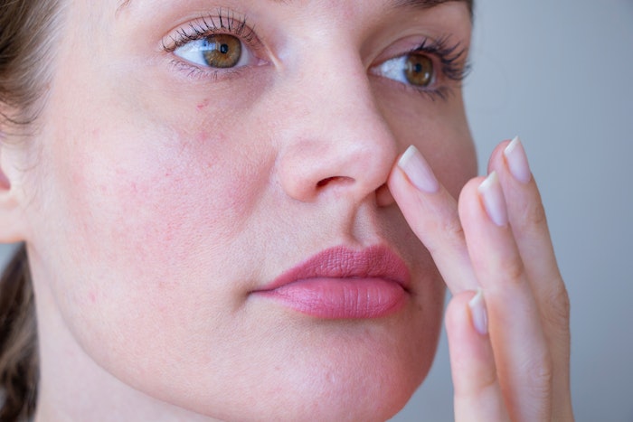Young woman with rosacea problem on face