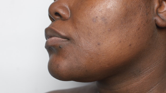 african american woman with skin blemishes, imperfect skin