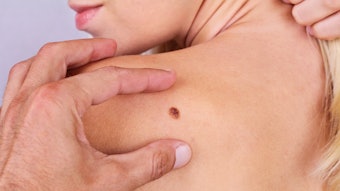 Doctor, dermatologist, hands examines a birthmark of patient. Checking benign moles