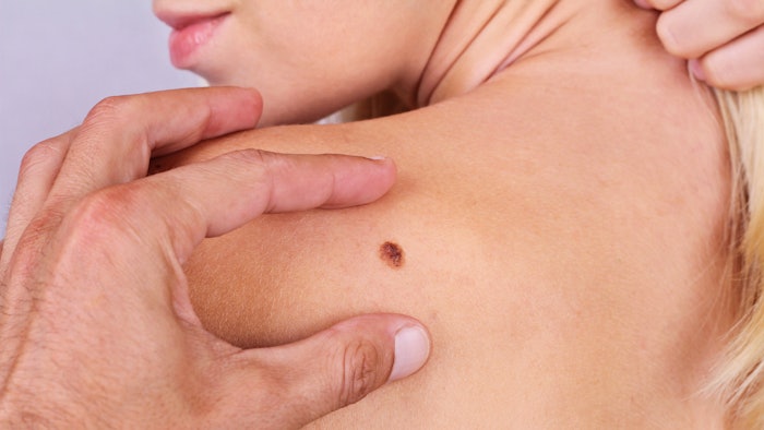 Doctor, dermatologist, hands examines a birthmark of patient. Checking benign moles