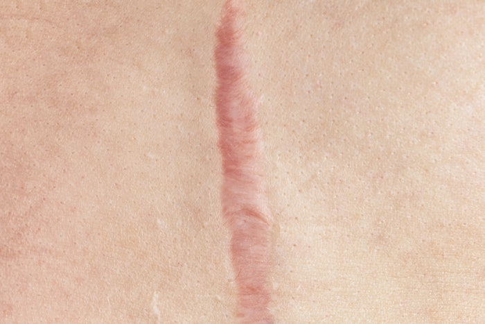 BioCorneum has now been folded into Nuance Medical's Biodermis portfolio of silicone scar management products.