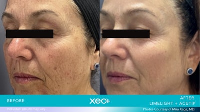 Xeo Plus B&a Limelight Acutip Kaga3 L