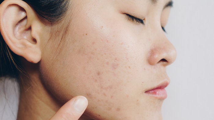 Asian woman has acne problems on her face.