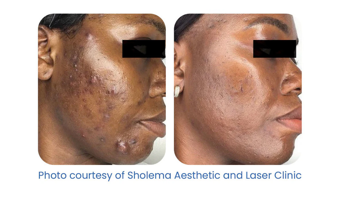 bpc 157 side effects acne nipple sensitivity Advanced Laser Device Targets Effectively Choose Your Bundle:50 Pack 17 in 1 Buy BPC-157 2026 |