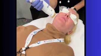 Managing Editor, Rebecca Lane, previously terrified of laser treatments and not a fan of pain in general, experiences a treatment with Aerolase's Neo Elite! Don't miss this exclusive video.