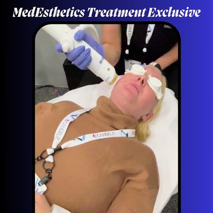 Managing Editor, Rebecca Lane, previously terrified of laser treatments and not a fan of pain in general, experiences a treatment with Aerolase's Neo Elite! Don't miss this exclusive video.