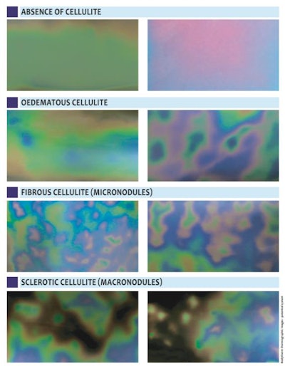 Different stages of cellulite progression.