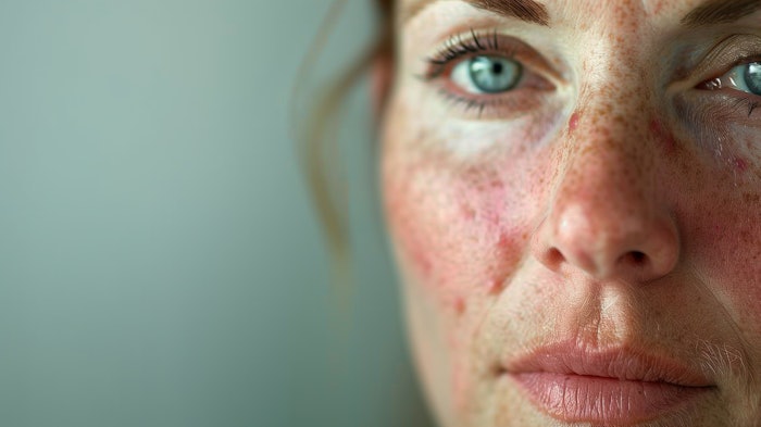 Close-up of a woman's face showing details of rosacea on her skin. Her green eyes and expression convey a sense of calmness despite the skin condition.