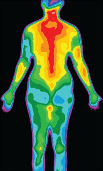 Thermal mapping of variations in skin temperature.