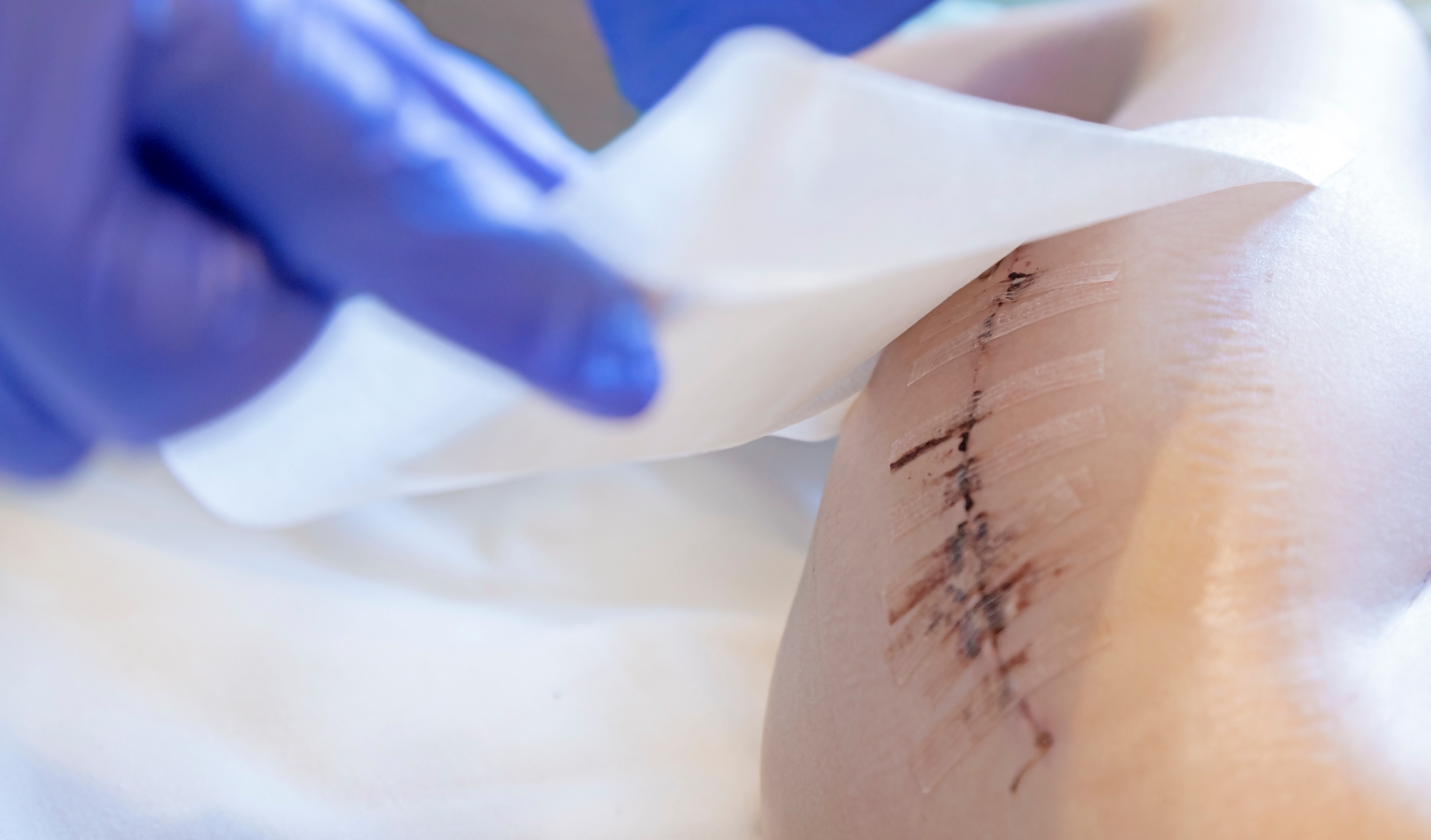 Experts share insights on the latest trends and innovations in scar treatments.