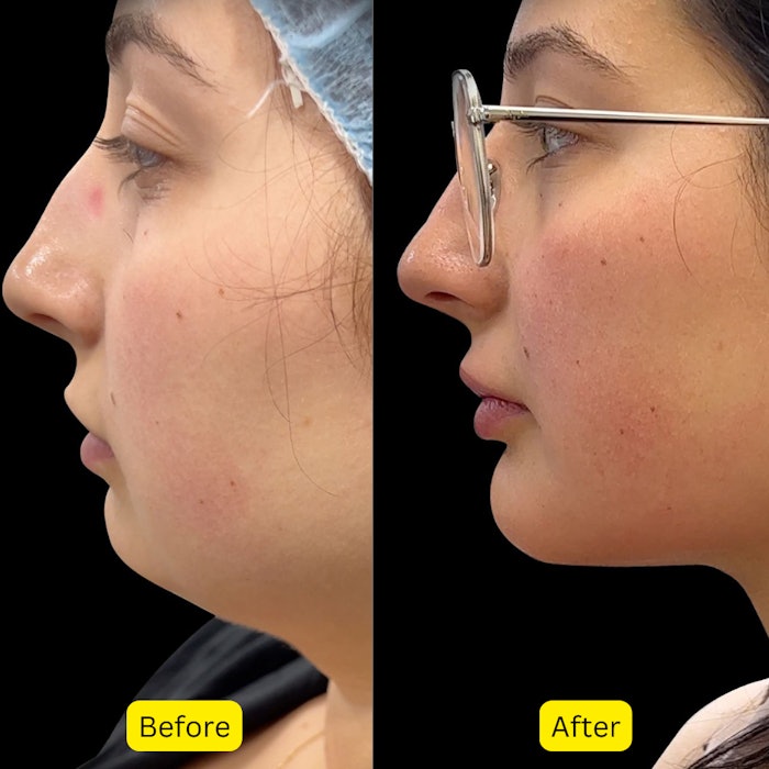 Baby facelift before and after.