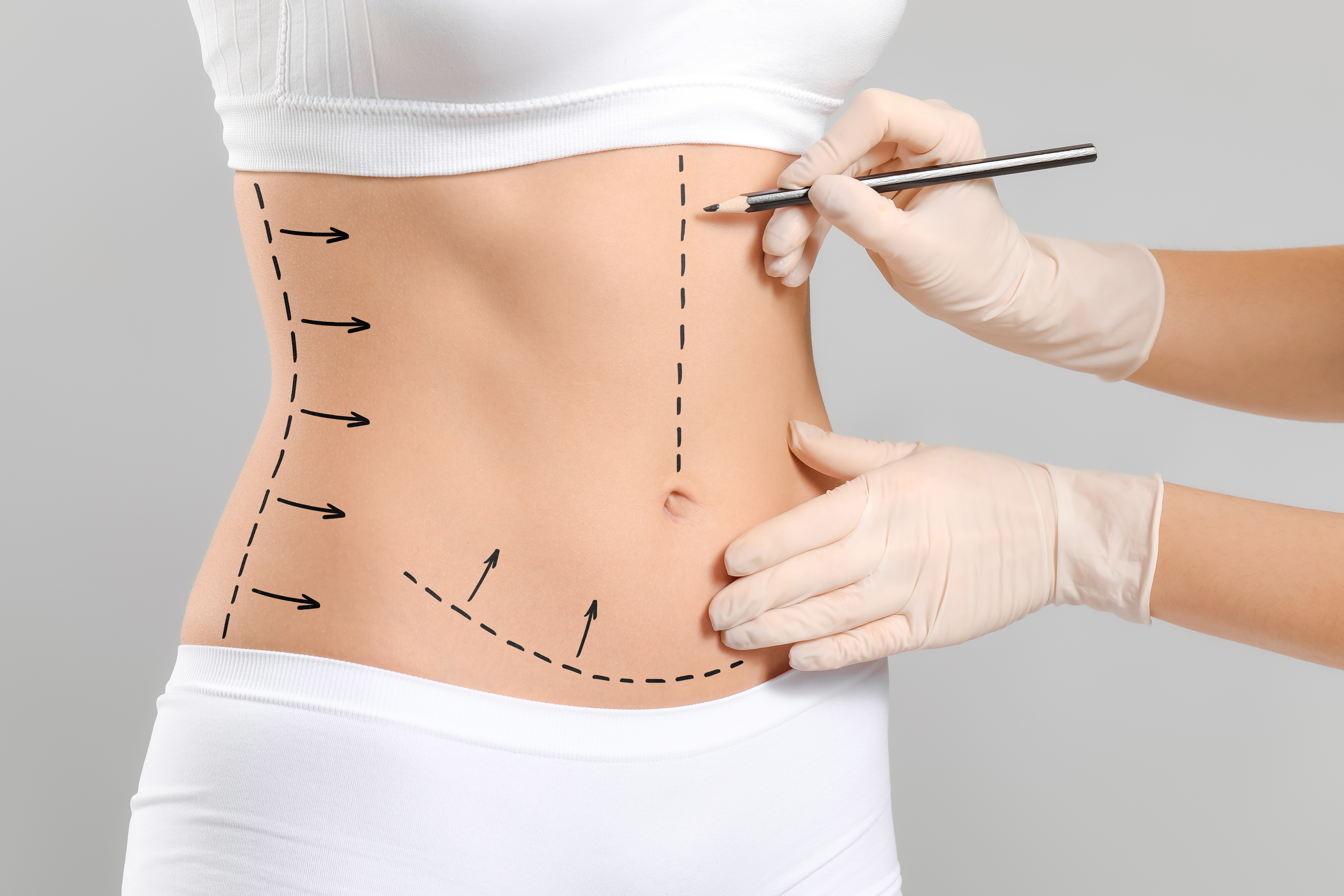 With the rise of GLP-1&rsquo;s popularity, there has been a noticeable increase in demand for procedures like tummy tucks, body lifts, and thigh lifts, per an NLM study.