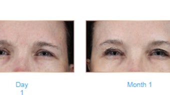 Before and after of Relfydess treating frown lines.