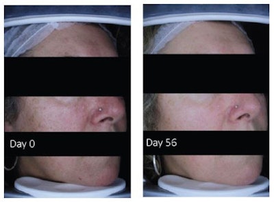 Skin brightening effects after 56 days of test product application
