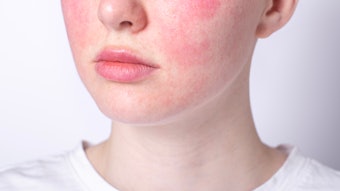 April is Rosacea Awareness Month, a month dedicated to educating the public on this chronic facial skin disorder.