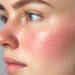 Neurotoxins, long recognized for their ability to smooth dynamic wrinkles, are now emerging as a groundbreaking treatment for inflammatory skin conditions.
