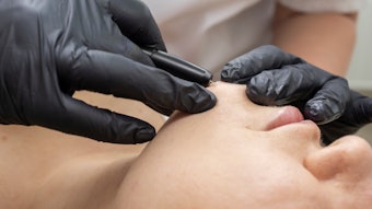 Electrolysis is the only permanent hair removal method that is FDA approved. Many women with PCOS and also transgender individuals, however, who sometimes remove hair to affirm their identities, are unaware it exists due to less popularity in the beauty industry.