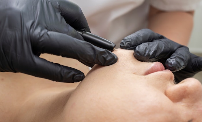 Electrolysis is the only permanent hair removal method that is FDA approved. Many women with PCOS and also transgender individuals, however, who sometimes remove hair to affirm their identities, are unaware it exists due to less popularity in the beauty industry.