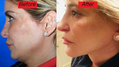 The vertical technique can be described as an upward lift, whereas traditional facelift techniques primarily pull the skin horizontally, making the mouth and eyes appear stretched.